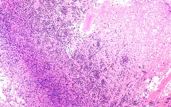 24O2 Emboli, septic (Case 24) A13 Spleen lesion 10X