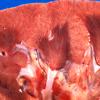 Infarct - Embolic