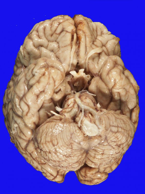 2A2 Aneurysm, ACA (Case 2) Coiled 1