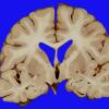 2A3 Aneurysm, ACA (Case 2) Coiled 5