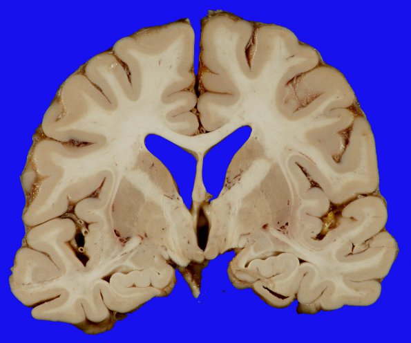 2A3 Aneurysm, ACA (Case 2) Coiled 5