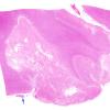 2B1 Infarct, subacute (Case 2) N18 H&E WM