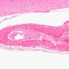 2B3 Infarct, subacute (Case 2) N18 H&E 10X