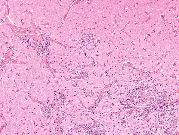 2B4 Infarct, subacute (Case 2) H&E 7