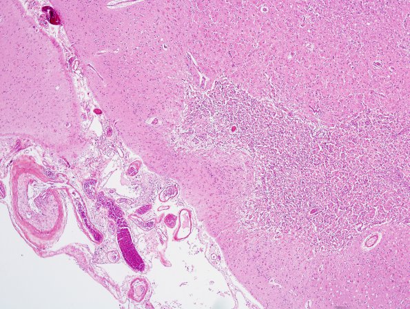 2C10 Infarcts, atheroembolic (Case 2) H&E 15