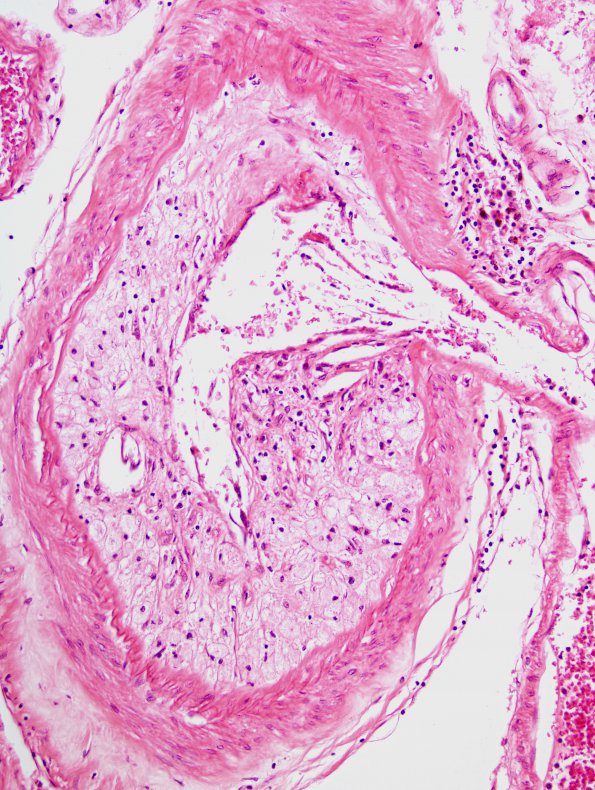 2C11 Infarcts, atheroembolic (Case 2) H&E 16