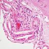 2C4 Infarcts, atheroembolic (Case 2) H&E 8