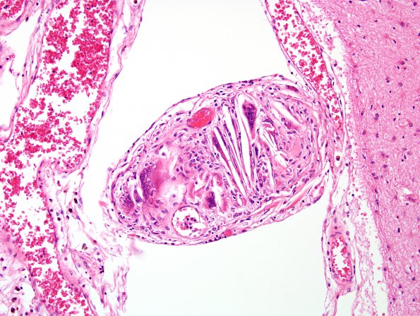 2C6 Infarct, subacute (Case 2) H&E 9