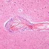 2C7 Infarct, subacute (Case 2) H&E 12