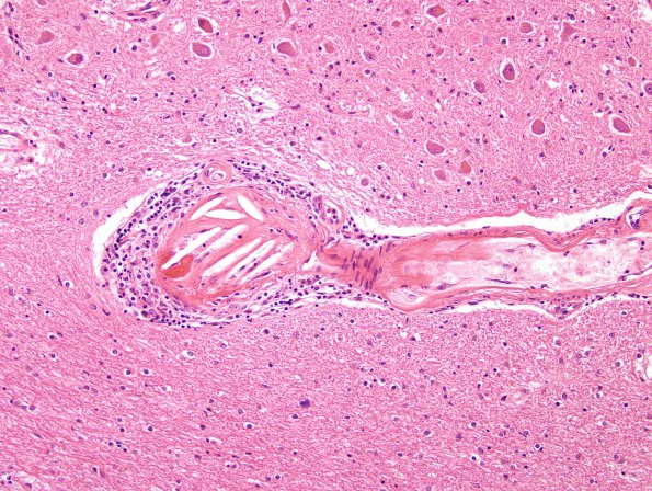 2C7 Infarct, subacute (Case 2) H&E 12