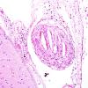 2C8 Aneurysm, Atheroemboli (Case 2) H&E 2