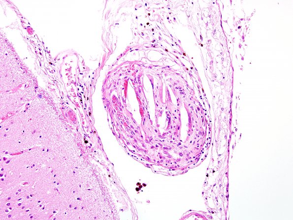 2C8 Aneurysm, Atheroemboli (Case 2) H&E 2