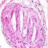 2C9 Infarct, subacute, (Case 2) H&E 8