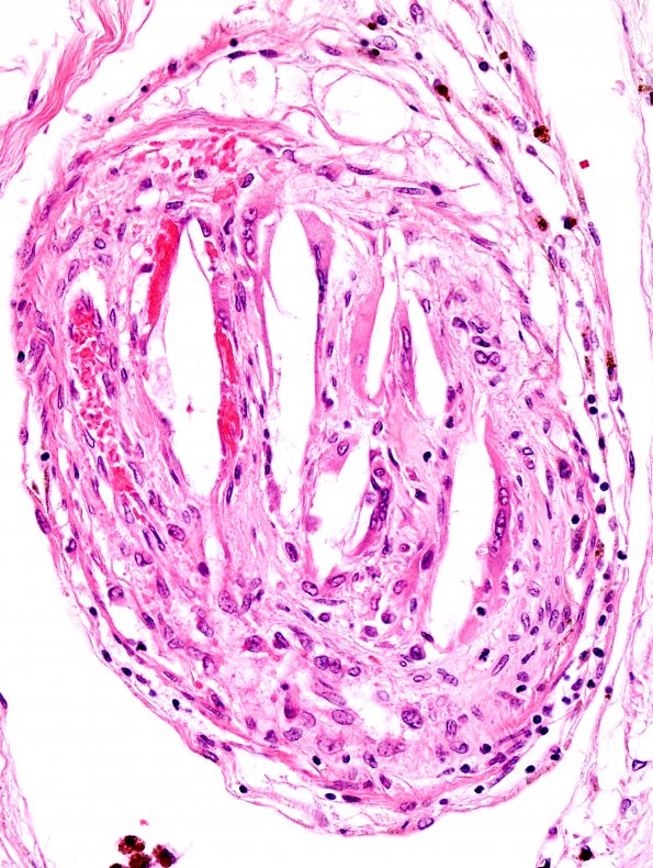 2C9 Infarct, subacute, (Case 2) H&E 8