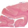 2D1 Infarct, subacute (Case 2) N5 Trichrome WM