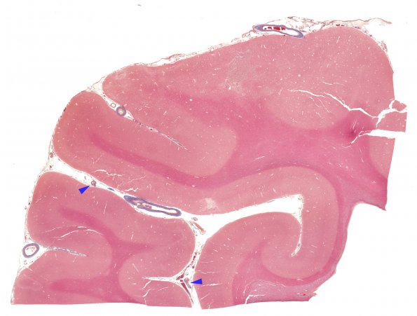 2D1 Infarct, subacute (Case 2) N5 Trichrome WM