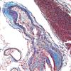 2D2 Infarcts, atheroembolic (Case 2) Trichrome 2