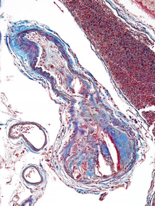 2D2 Infarcts, atheroembolic (Case 2) Trichrome 2