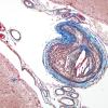 2D3 Infarcts, atheroembolic (Case 2) Trichrome 1