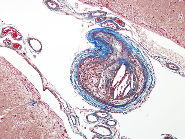 2D3 Infarcts, atheroembolic (Case 2) Trichrome 1