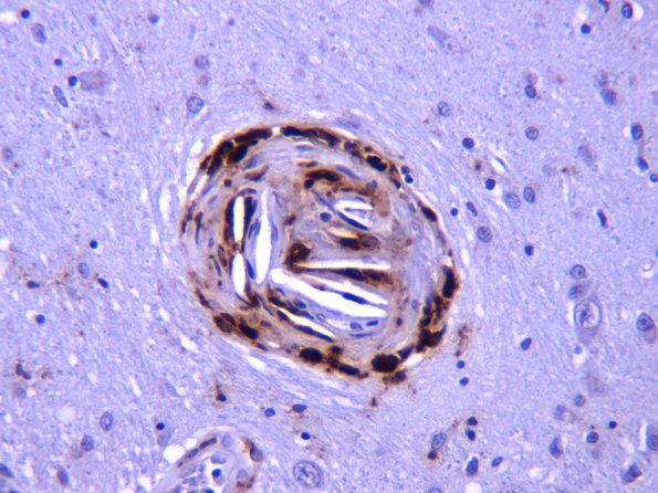 2D4 Infarcts, atheroembolic (Case 2) CD68 1