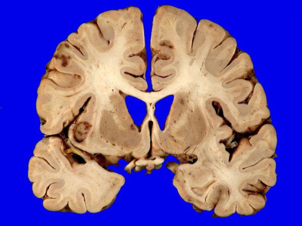 3A2 Infarcts, embolic, septic (Case 3) 6