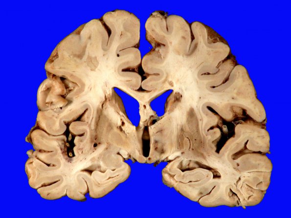 3A4 Infarcts, embolic, septic (Case 3) 8