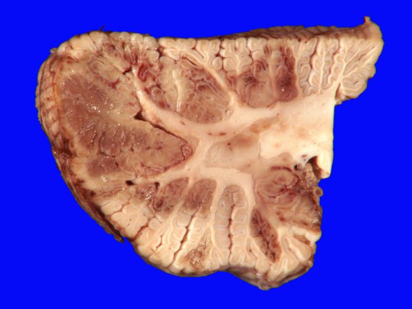 3A5 Infarcts, embolic, septic (Case 3) 30