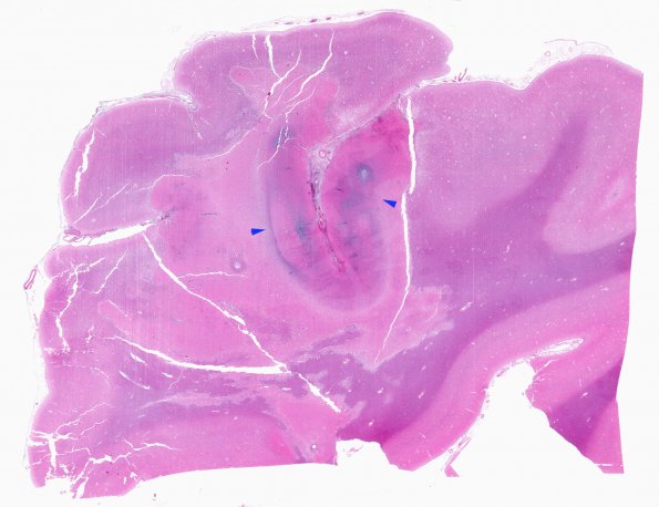 3B1 Infarcts, embolic, septic (Case 3) H&E WM 2 copy