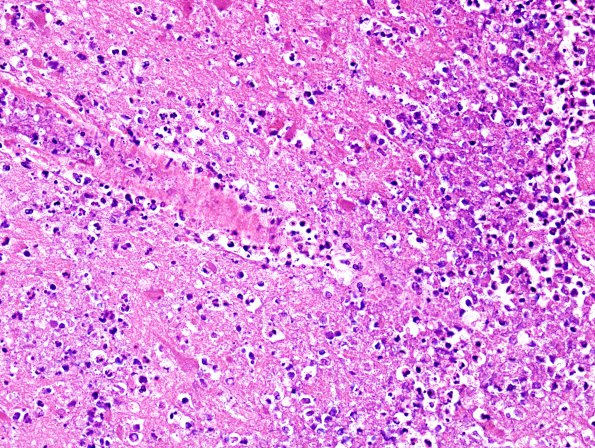 3B3 Infarcts, embolic, septic (Case 3) H&E 17