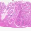 3C1 Infarcts, embolic, septic (Case 3) H&E WM copy