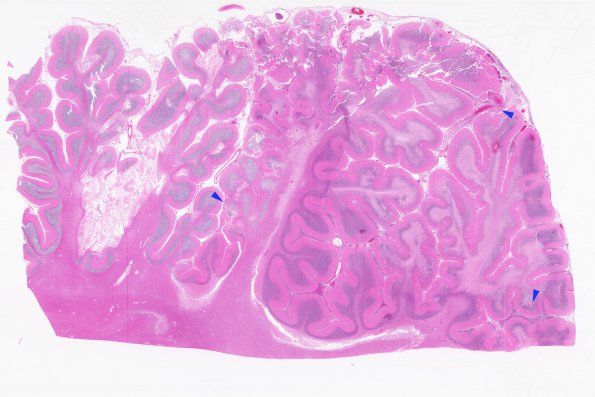 3C1 Infarcts, embolic, septic (Case 3) H&E WM copy