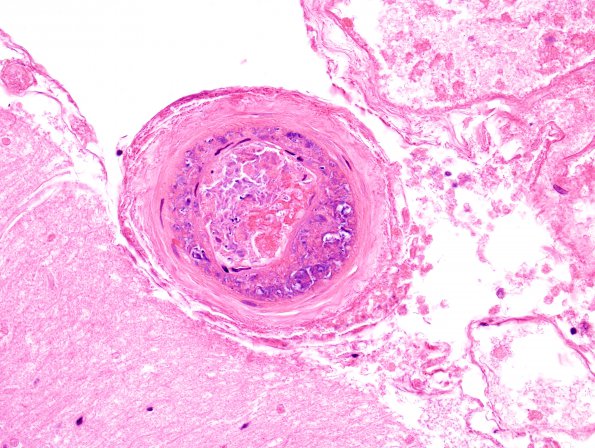 3C5 Infarcts, embolic, septic (Case 3) H&E 3