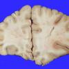 4A2 Infarct, embolic (Case 4) 4