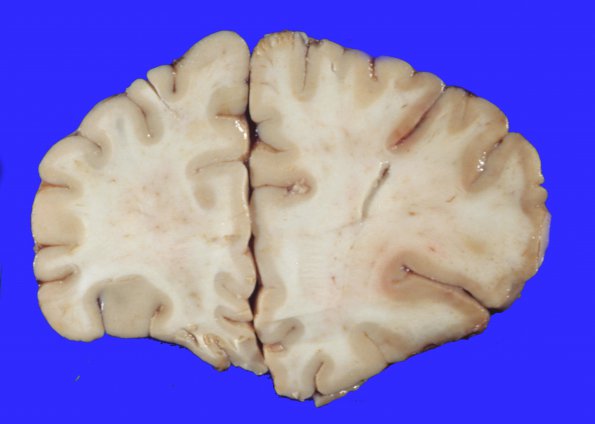 4A2 Infarct, embolic (Case 4) 4