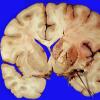 4A3 Infarct, recent (Case 4) original