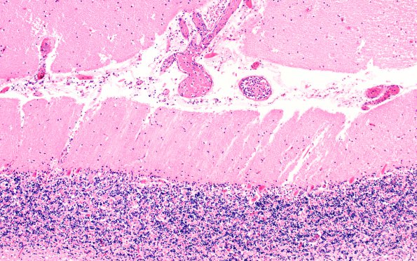 4B5 Infarct, embolic (Case 4) P H&E 10X