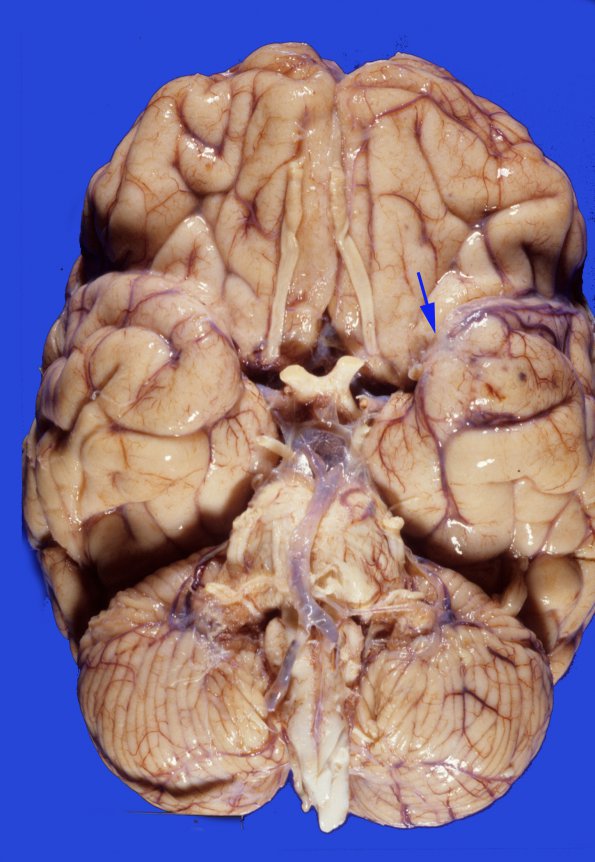 5A1 Infarcts, embolic, ChondroSA (Case 5)  9 copy