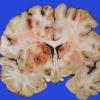 5A2 Infarct, Embolic, Chondrosarcoma (Case 5)32a