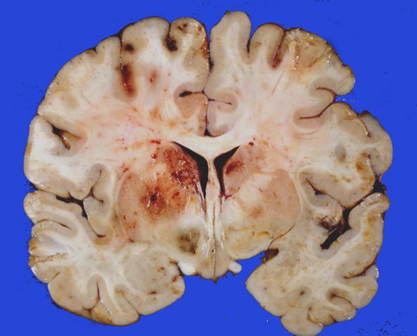 5A2 Infarct, Embolic, Chondrosarcoma (Case 5)32a