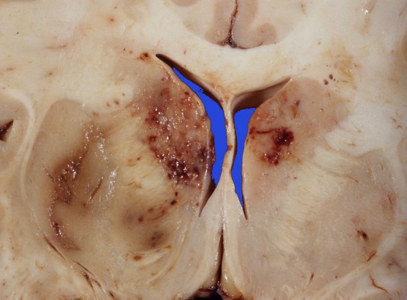 5A3 Infarcts, embolic, ChondroSA (Case 5)  6