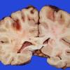 5A Infarcts, embolic, ChondroSA (Case 5) 21