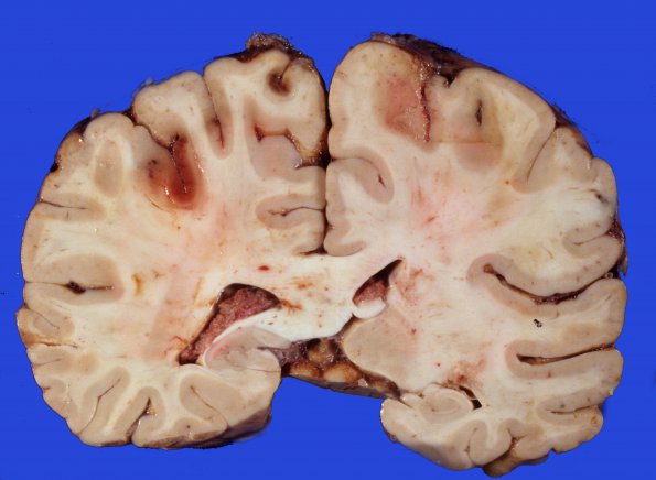 5A Infarcts, embolic, ChondroSA (Case 5) 21