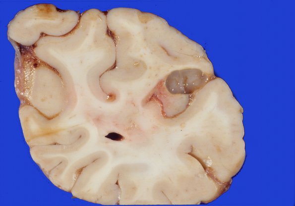 5A5 Infarcts, embolic, ChondroSA (Case 5)  3