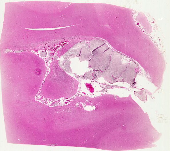 5B1 Infarcts, embolic, chondrosarcoma (Case 5) H&E WM 3