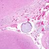 5B2 Infarcts, embolic, chondrosarcoma (Case 5) H&E 2