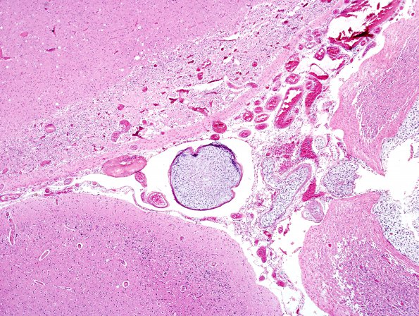 5B2 Infarcts, embolic, chondrosarcoma (Case 5) H&E 2