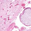 5B3 Infarcts, embolic, chondrosarcoma (Case 5) H&E 3