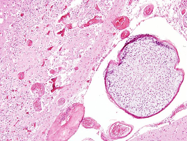 5B3 Infarcts, embolic, chondrosarcoma (Case 5) H&E 3