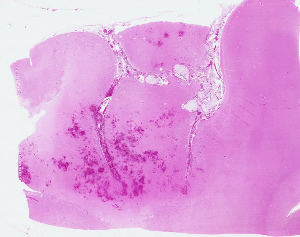 5B4 Infarcts, embolic, ChondroSA (Case 5) G H&E  WM